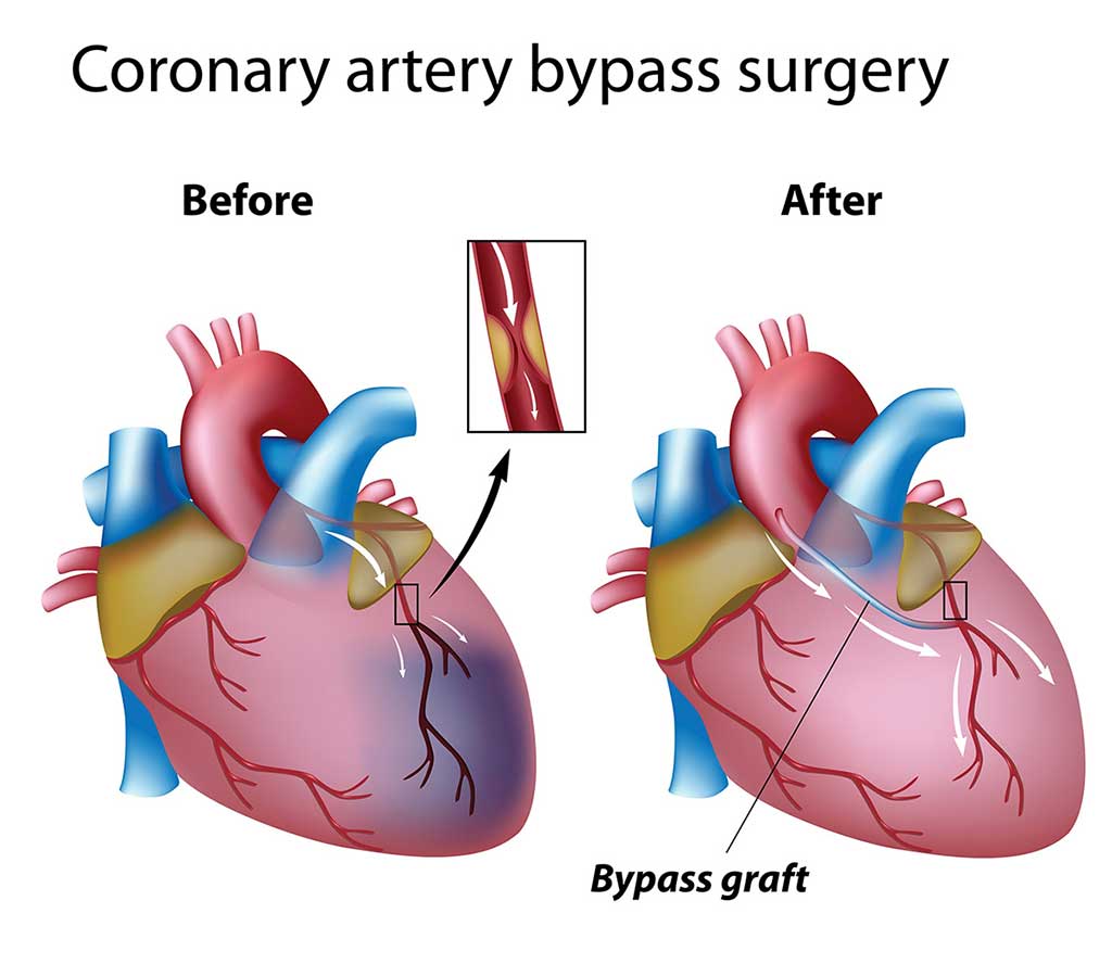 Ilustración de un bypass coronario