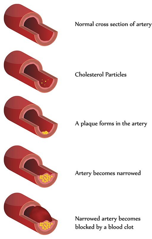 Ilustración de la progresión de la aterosclerosis