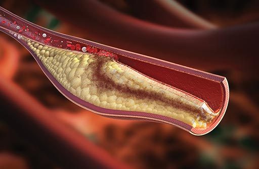LDL cholesterol can build up in arteries
