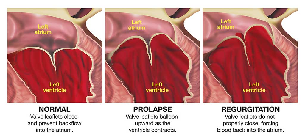 Ilustración del prolapso de la válvula mitral frente al estado normal y de regurgitación