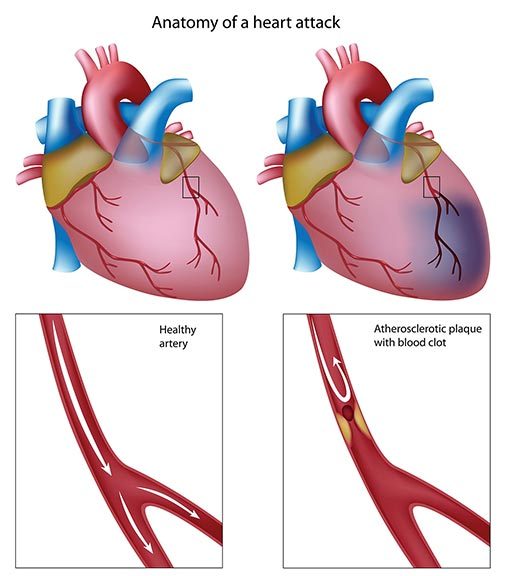 Anatomía de un infarto (ilustración)