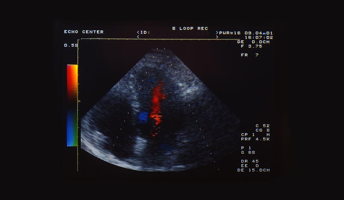 An ultrasound of a VGE