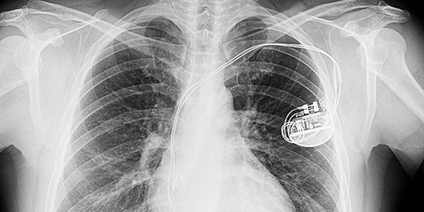X-ray of person with a pacemaker