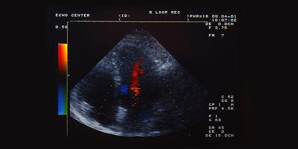 ultrasound of bubbles in the lungs