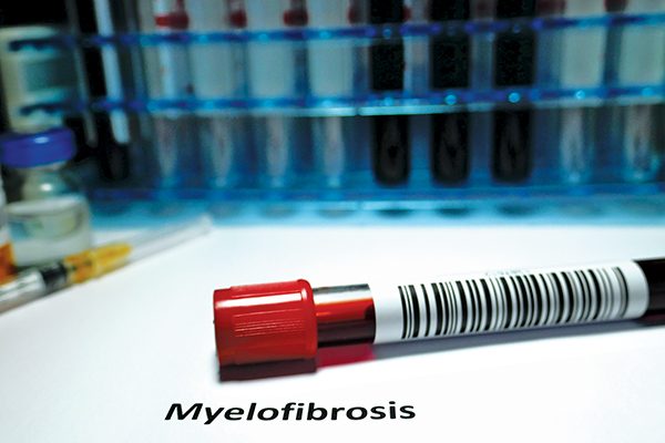 vial de sangre para detectar mielofibrosis