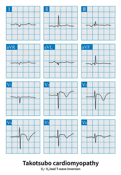 electrocardiograms of takotsubo cardiomyopathy