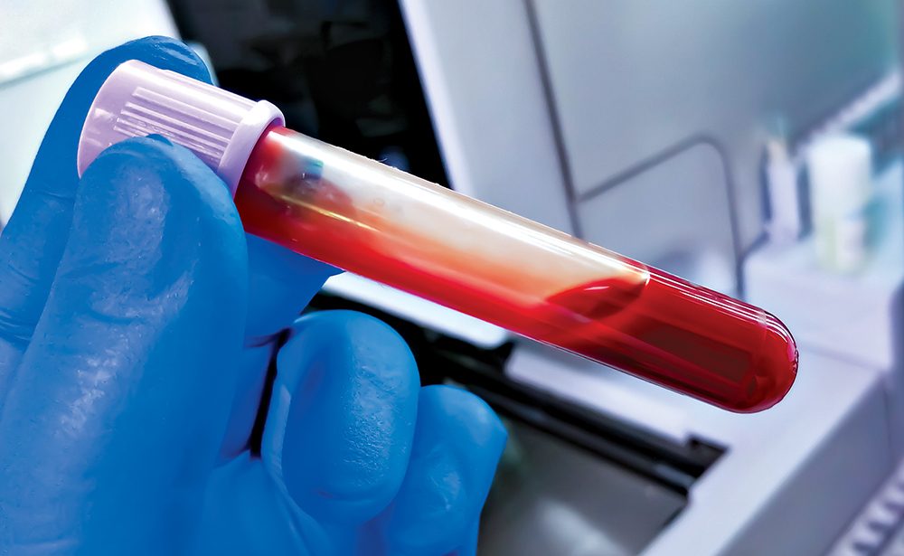 Mano sosteniendo muestra de sangre en tubo de vacío para análisis hematológico.