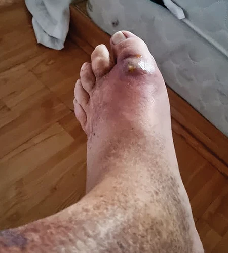 The swelling and pain was incredibly significant from what started as nothing more than a small blister on the author’s left big toe