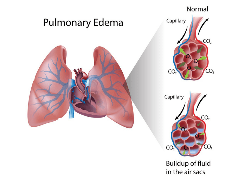 Pulmonary edema of the lungs