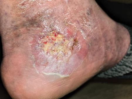 A serious Vibrio infection