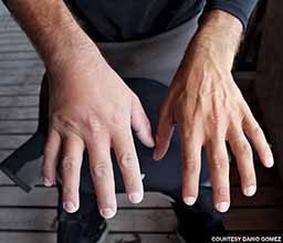 A man shows his swollen hand compared to his non-swollen hand.