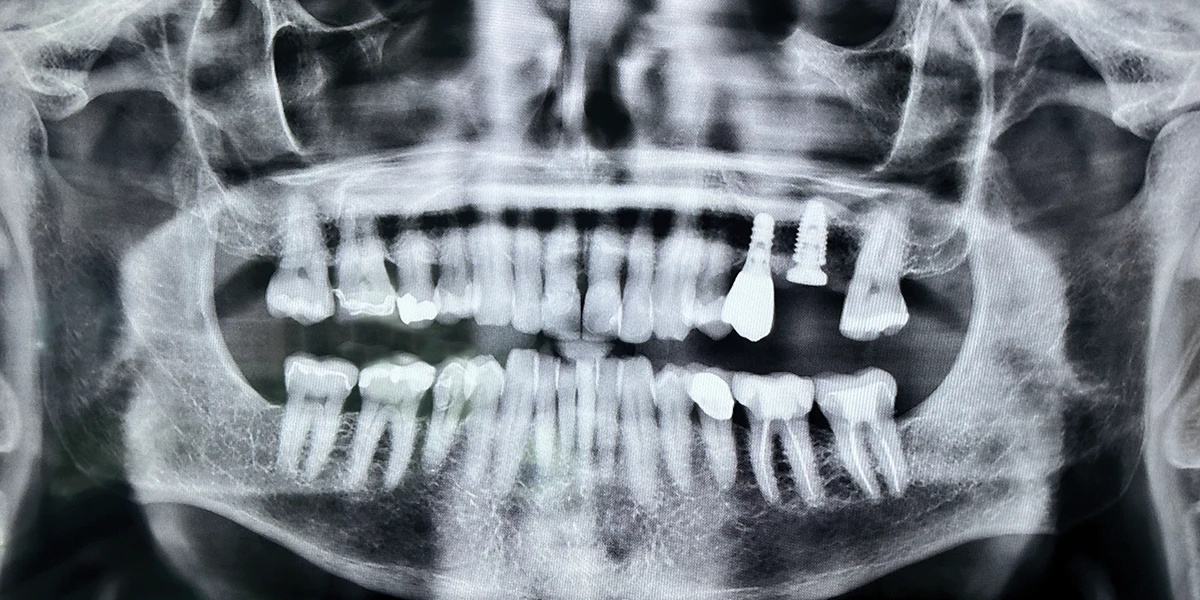 dental implants